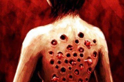 ​玉米男孩是什么病寄生虫的故事是真的吗