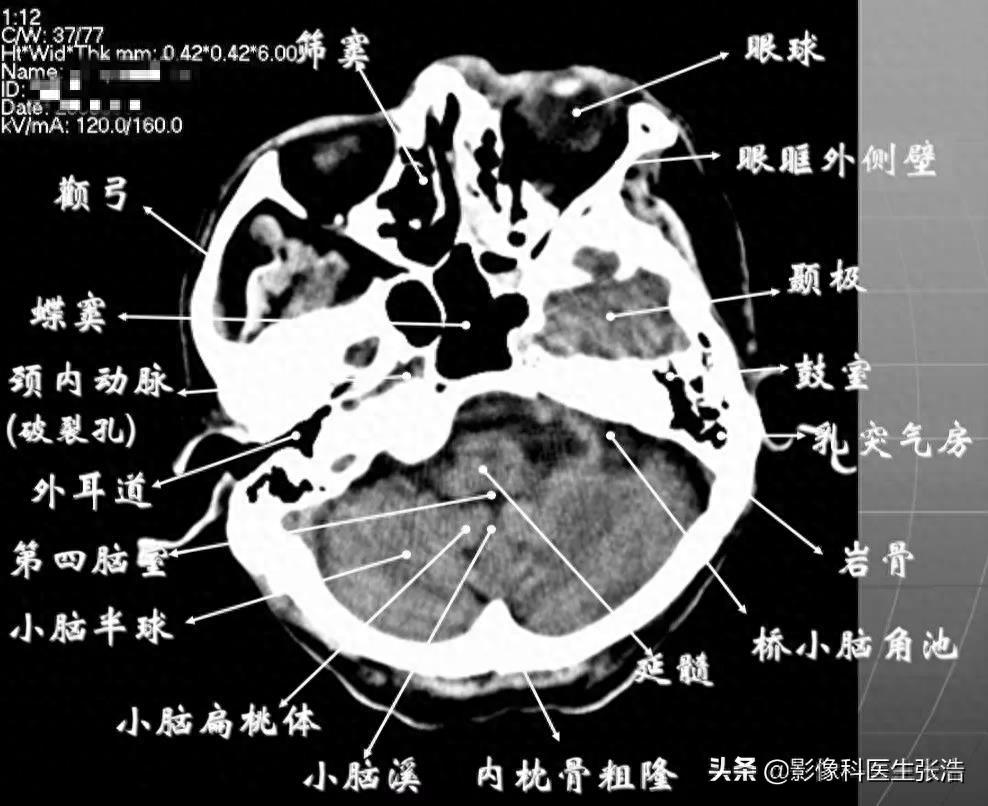头颅脑部CT横断面解剖图，附带解剖标注，方便学习收藏