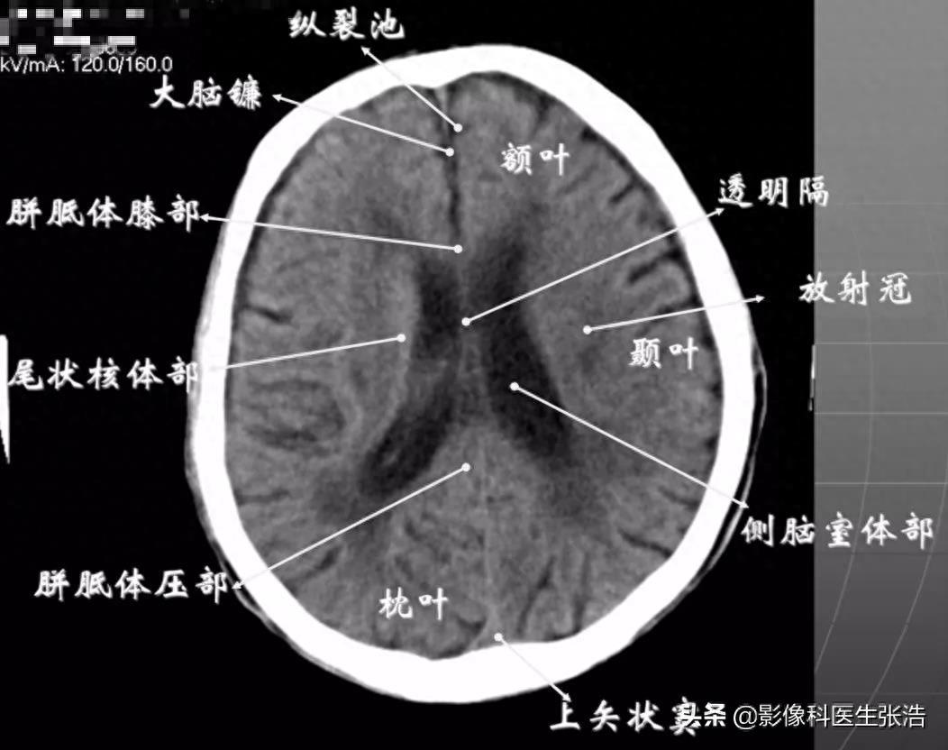 头颅脑部CT横断面解剖图，附带解剖标注，方便学习收藏