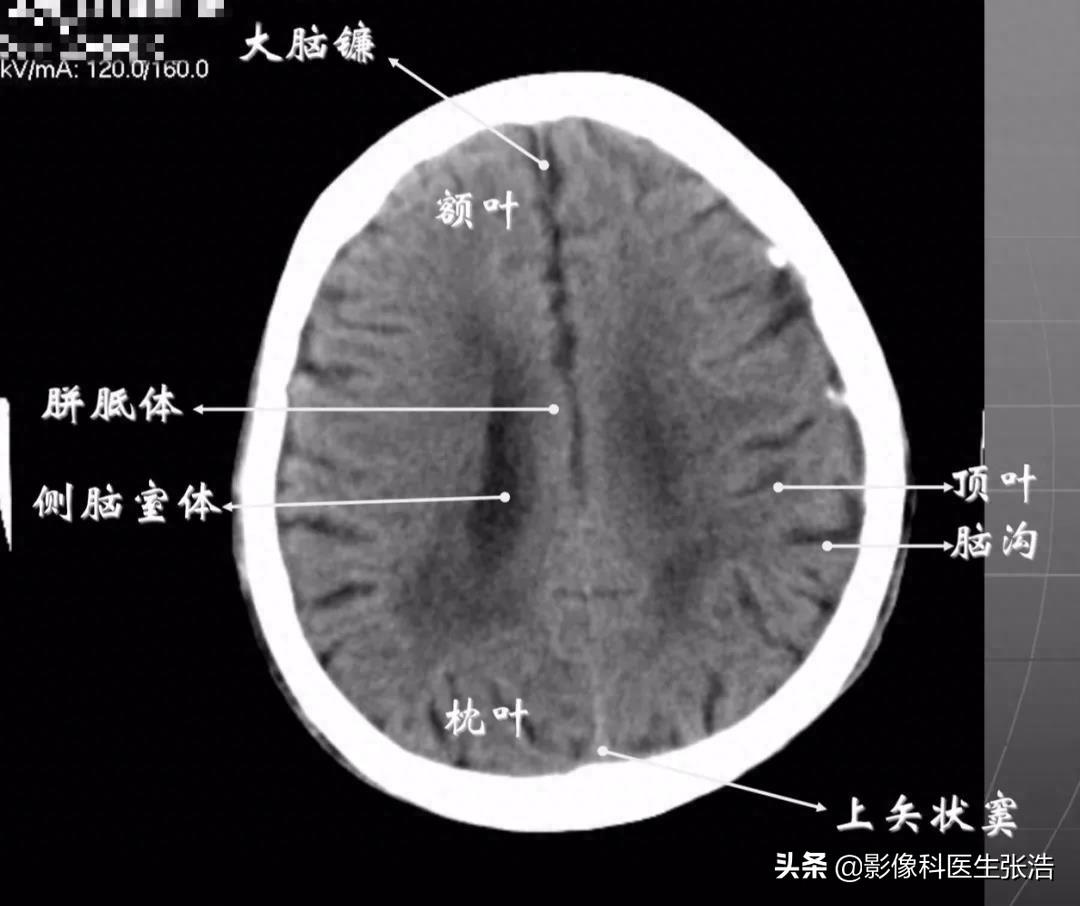 头颅脑部CT横断面解剖图，附带解剖标注，方便学习收藏