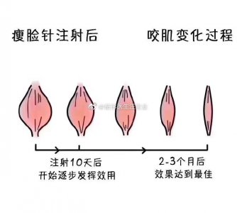 ​瘦脸针术后对比图