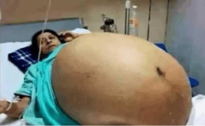 ​女子肚大如鼓, 竟生下11胞胎, 结果却让全家人犯愁!