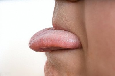 ​舌头上有白色的斑点，是怎么回事？舌头白斑病是艾滋病的象征吗？