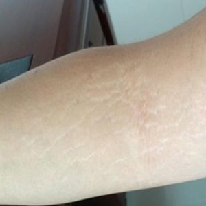 ​肥胖纹怎么去掉（消除肥胖纹的首选产品）