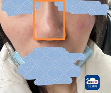 ​315｜ 鼻子“线雕”有风险！